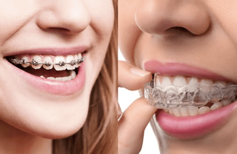 invisalign-braces