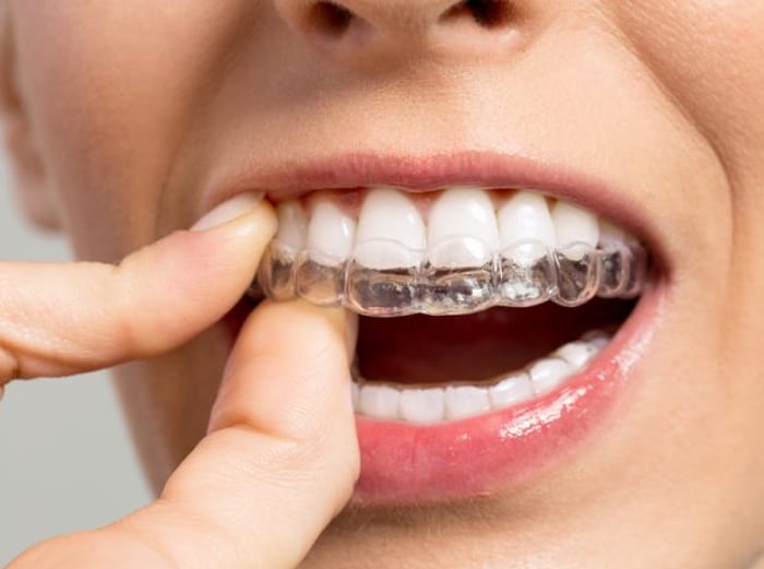 Invisalign®