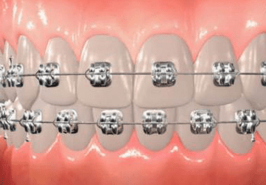 braces