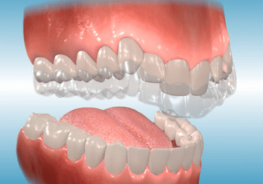 clear aligners