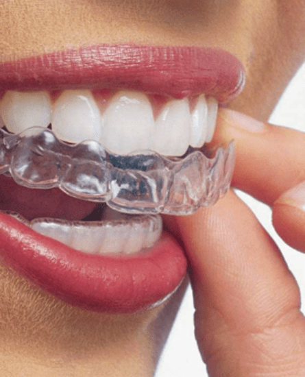 Invisalign®